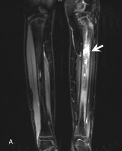 Diagnosis – CRMO Awareness